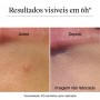 Neutrogena Clear & Defend+ Pensos para Borbulhas Pele Sensível 30 unidades